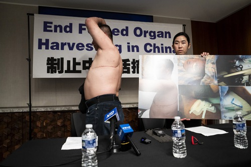 Mr. Cheng showed the sutured incision on the left side of his upper body during the press conference on July 3.